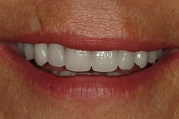 After: the same smile with a fixed arch of teeth on implants.