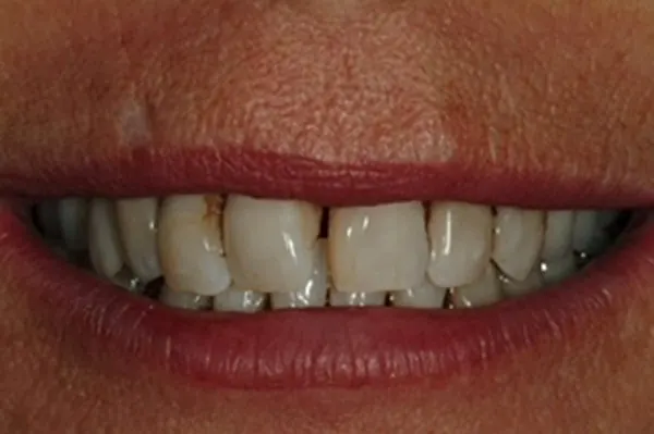 Before: worn, stained and uneven teeth before hybrid implant treatment.