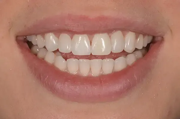 After: the gaps closed with bonding.