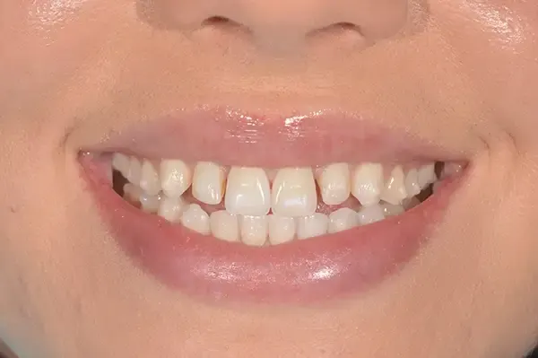 Before: gaps between the front teeth.