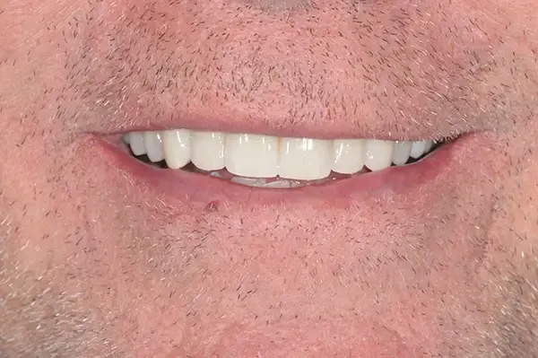 After: the same smile after a fixed bridge.