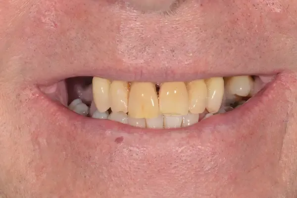 Before: missing and discoloured upper teeth.