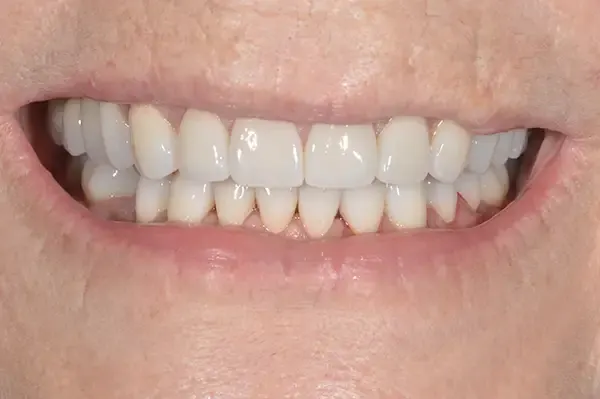 After: the same teeth restored with porcelain crowns.