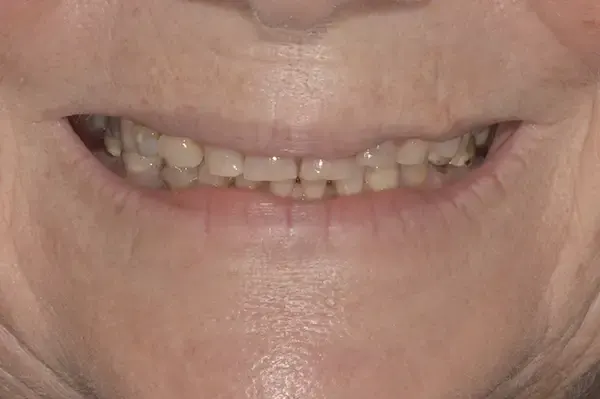 Before: worn, uneven and discoloured front teeth.