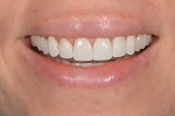 After: the same smile with porcelain veneers.