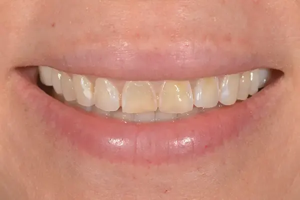 Before: yellowed front teeth of uneven shape.